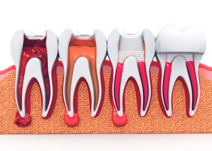 Endodonti