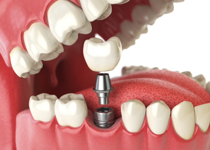 implant Tedavisi Nasıl yapılır
